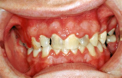 Acute Herpetic Gingivostomatitis - Stock Image - C036/5836 - Science Photo Library