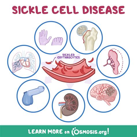 Sickle Cell Anemia Symptoms