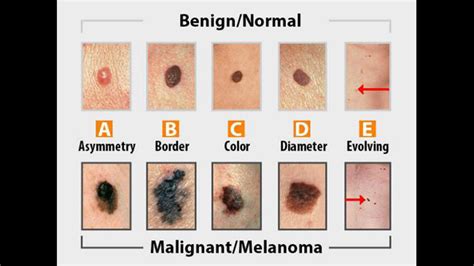 What to look for during a skin cancer self-exam | WOODTV.com