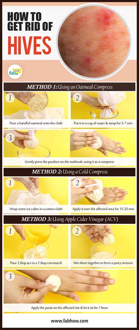 22 best Hives images on Pinterest | Hives remedies, Natural home ...