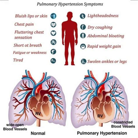 Pin on Pulmonary Hypertension (PH)