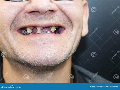 Rotten Teeth. Royalty-Free Stock Image | CartoonDealer.com #35981548