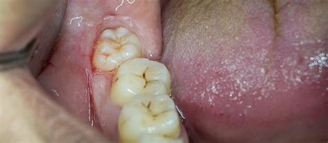 Wisdom Teeth Symptoms | Hermitage Dental Group | Hermitage, TN