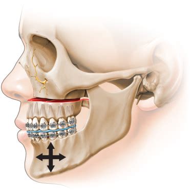 Maxillary Le Fort 1 Osteotomy Treatment for Abroad Patients In India