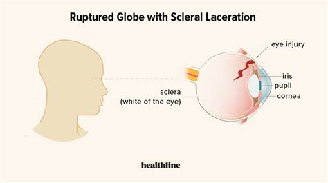 Treating a Ruptured Eye: What to Know About This Ocular Emergency