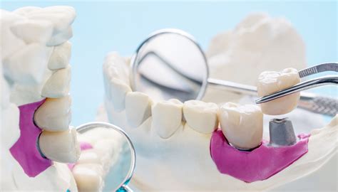 An Educational Guide On Prosthodontist | Dental Career Services