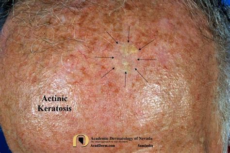 Actinic Keratosis: Treatment-Cryotherapy - Academic Dermatology of Nevada