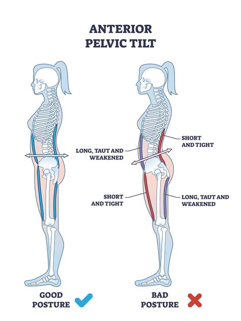 How To Fix Anterior Pelvic Tilt Posture - Chatfield Family & Sports ...