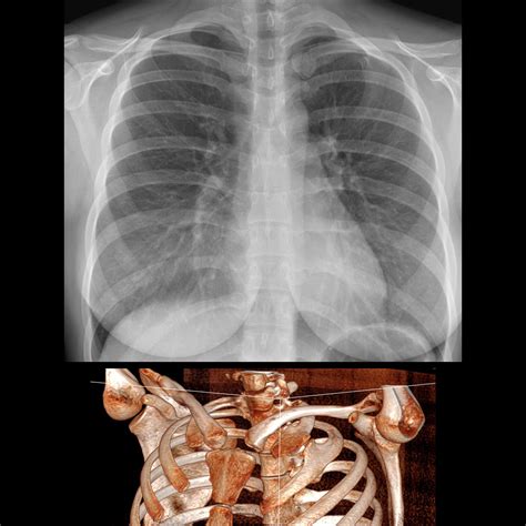 Pediatric Rib Fusion | Pediatric Radiology Reference Article | Pediatric Imaging | @pedsimaging