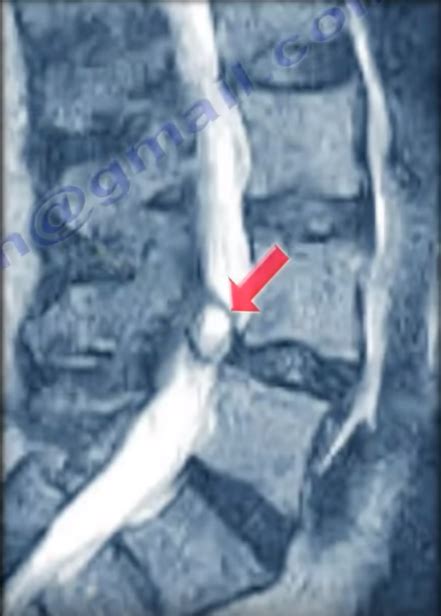 Synovial Cyst of the Spine. Synovial cyst of the spine is an… | by Nabil Ebraheim | Medium