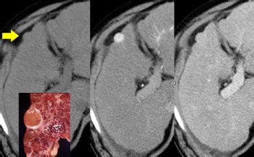 Top 5 low density liver lesion on ct scan 2022