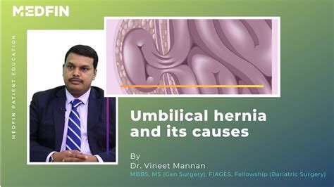 Umbilical Hernia Causes Symptoms And Treatments – Otosection