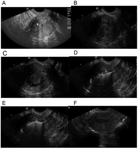 Diagnosis and treatment of submucous myoma of the uterus with interventional ultrasound