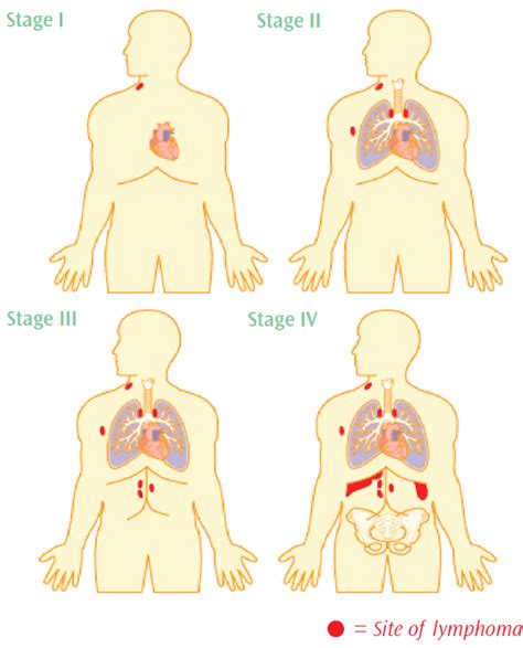 Non-Hodgkin Lymphoma Staging - Understand the Different Stages