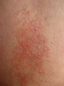 Lichen Simplex Chronicus (Neurodermatitis) — Causes and Symptoms