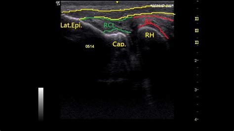 Medial Collateral Ligament Elbow Ultrasound