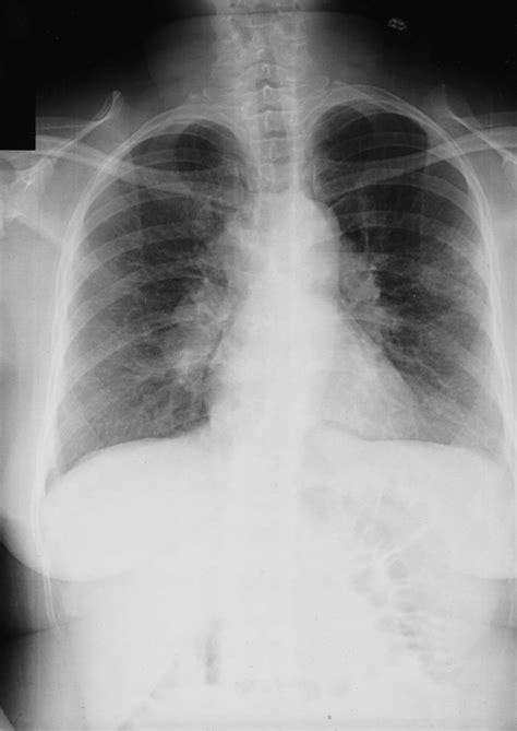 Chest X-ray demonstrating bilateral hilar lymphadenopathy in a female... | Download Scientific ...