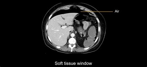 Abdominal CT: bowel perforation • LITFL • Radiology Library