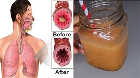 How To Get Rid Of Phlegm In Throat - Sheetfault34