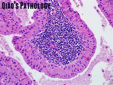 Qiao's Pathology: Warthin's Tumor of Parotid Gland - a photo on Flickriver