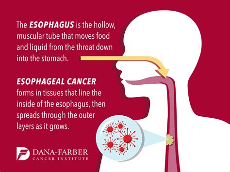 Signs and Symptoms of Esophageal Cancer | Dana-Farber Cancer Institute