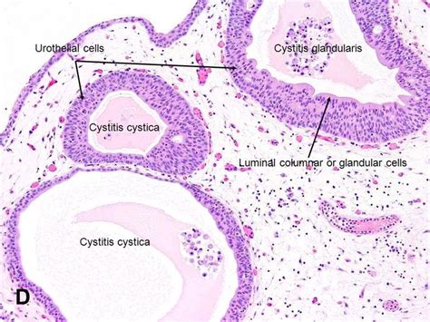 American Urological Association - Cystitis Cystica