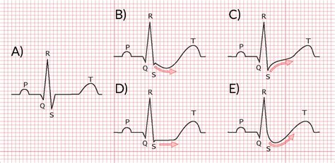 Stable Angina Vs Unstable Angina Ecg : Unstable Angina Pathophysiology Definition Stemi And ...