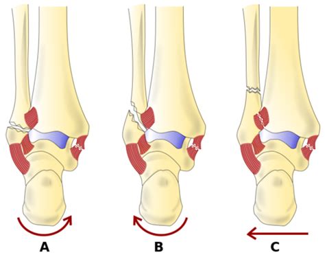 Fibular Fracture - Physiopedia