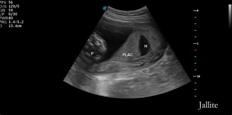 Hematoma Retroplacentario