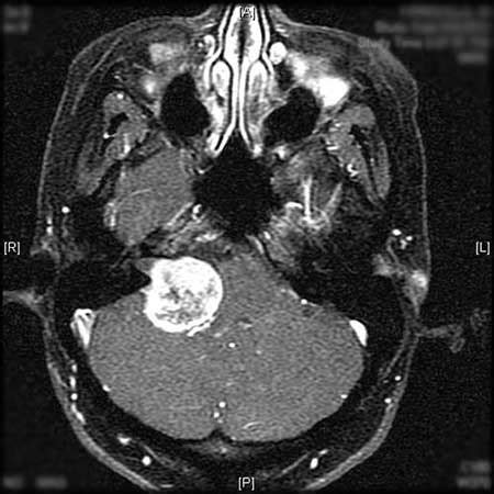 Pictures of Acoustic Neuromas | Weill Cornell Brain and Spine Center