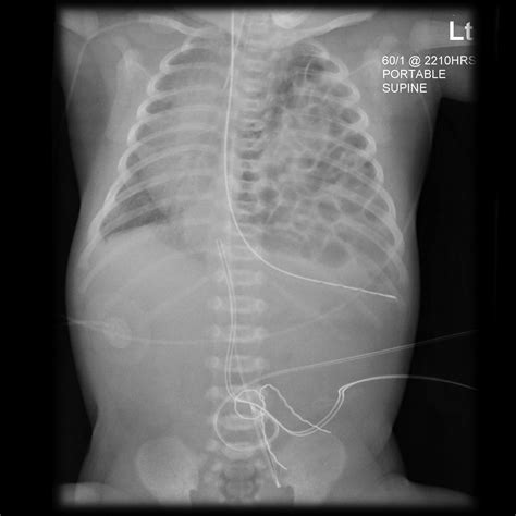 Congenital diaphragmatic hernia chest x ray - wikidoc