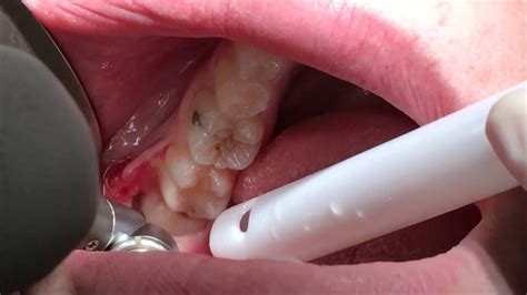 Surgical extraction of horizontally impacted 38. Wisdom tooth extraction Ipswich - YouTube