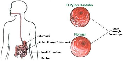 » Ulcers and H. Pylori