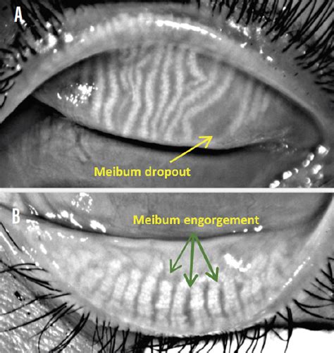 Essentials for Diagnosing OSD - Modern Optometry