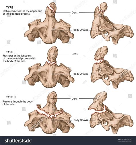 C2 C3 Vertebrae Fracture - Symptoms, Diagnosis, Treatment - Rxharun