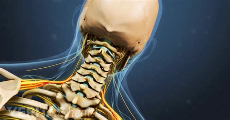 Cirugía de corpectomía vertebral cervical anterior