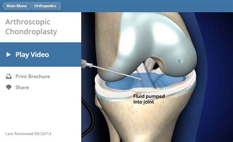 Arthroscopic Knee Surgery NYC | Manhattan Orthopedic Care