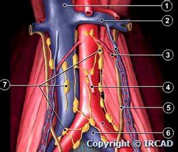 Para Aortic Lymph Node Removal