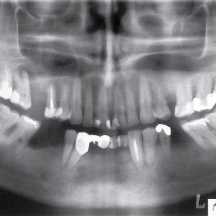 Panoramic radiograph. | Download Scientific Diagram