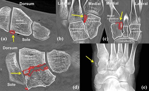 Cuneiform Bone Fracture