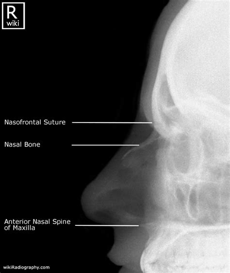 Nasal Bone Xray