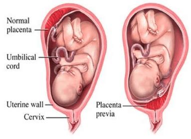 What is a placenta? How does it affect me? – 3D/4D/HD Ultrasound