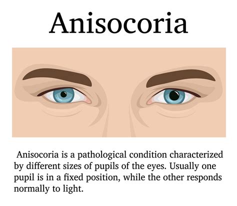 Anisocoria | Eye Patient