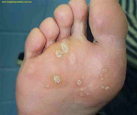 Plantar Warts | Hampton Podiatry