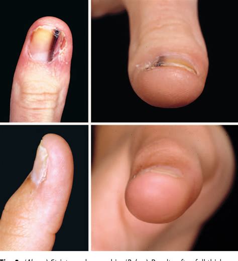 Figure 2 from Subungual melanoma: a review of current treatment. | Semantic Scholar