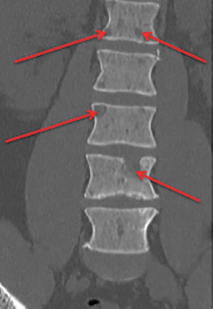 Multiple Myeloma | Consultant360