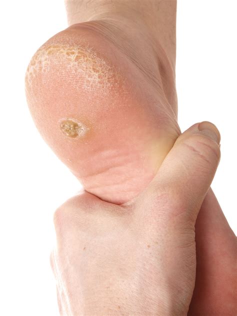 Plantar Warts - All Ages Podiatry & Mobility