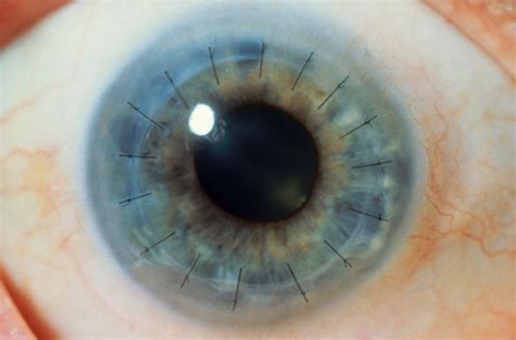 Corneal transplantation in Iran – Dr. Mehran Zarei GhanavatiCorneal transplantation in Iran ...