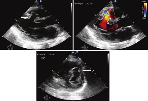 Ventricular Septal Defect