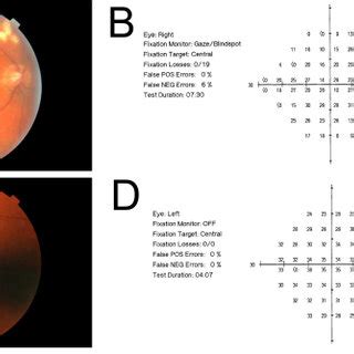 Fundus photographs for Patient V:6. The cup/disc ratio is 0.5 in the ...